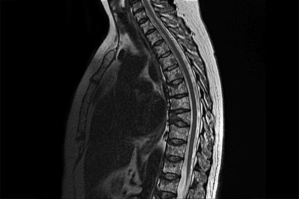 Manifestaciones de osteocondrosis torácica a la imagen de la resonancia magnética