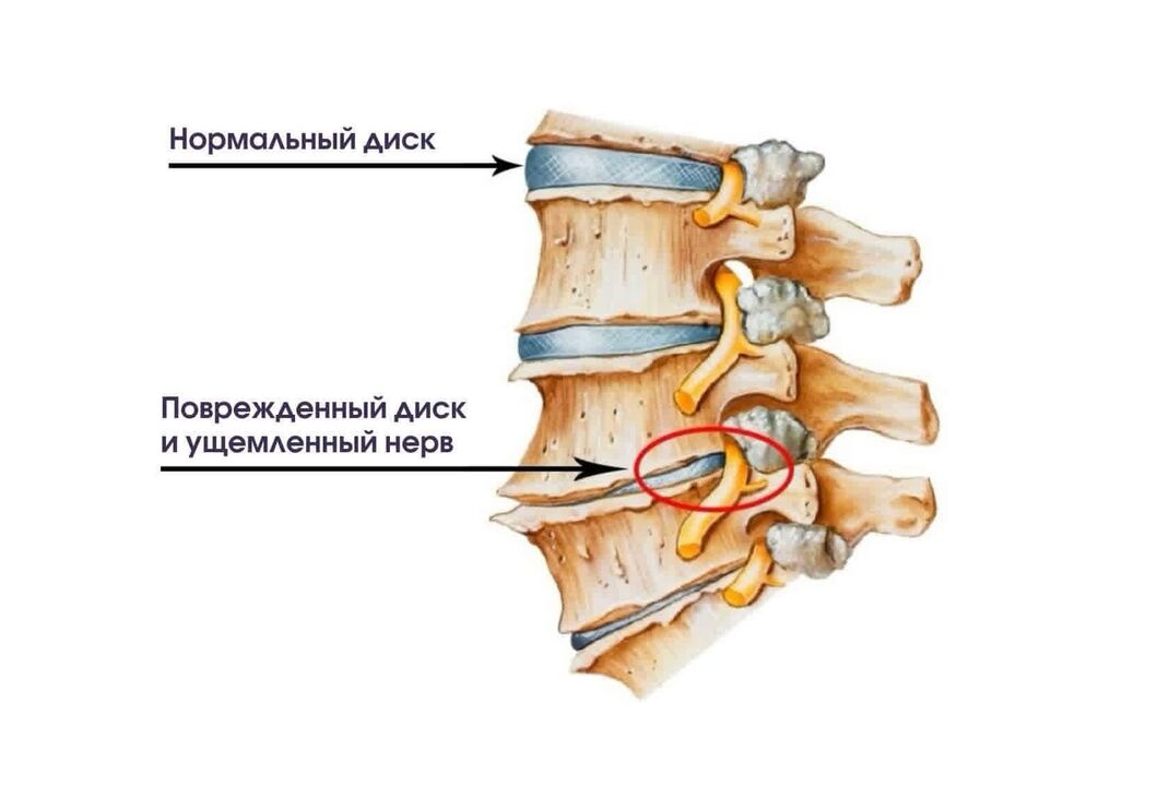 Síntomas de osteocondrosis cervical