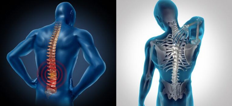 Inflamación en la osteocondrosis espinal.