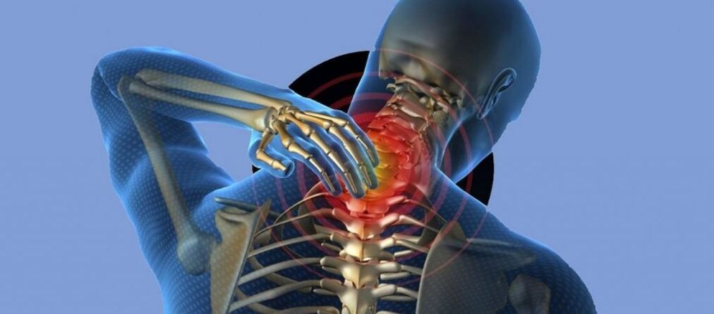 Osteocondrosis de la columna cervical.