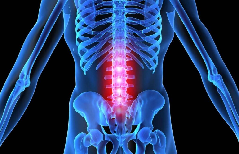Osteocondrosis de la columna lumbar.