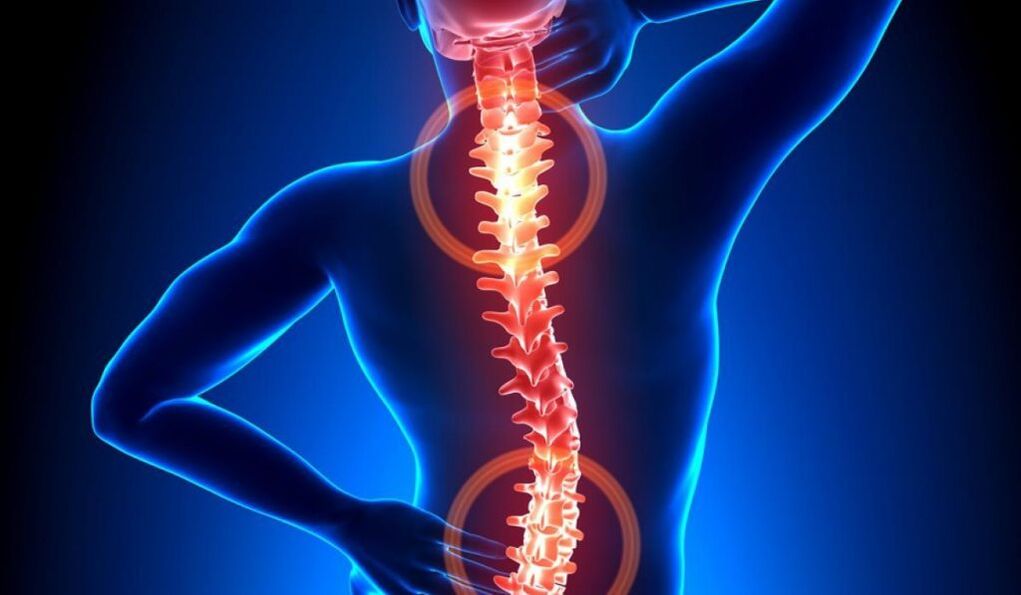 osteocondrosis espinal
