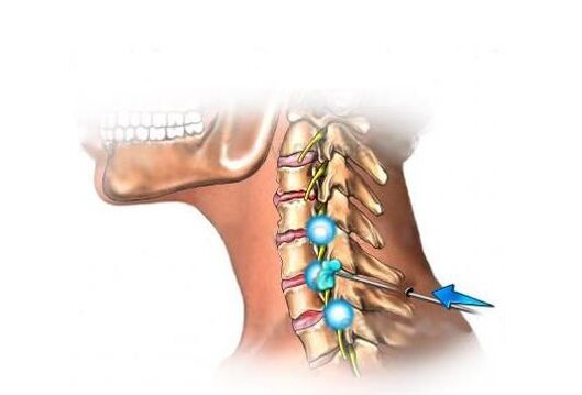 tratamiento de la osteocondrosis cervical